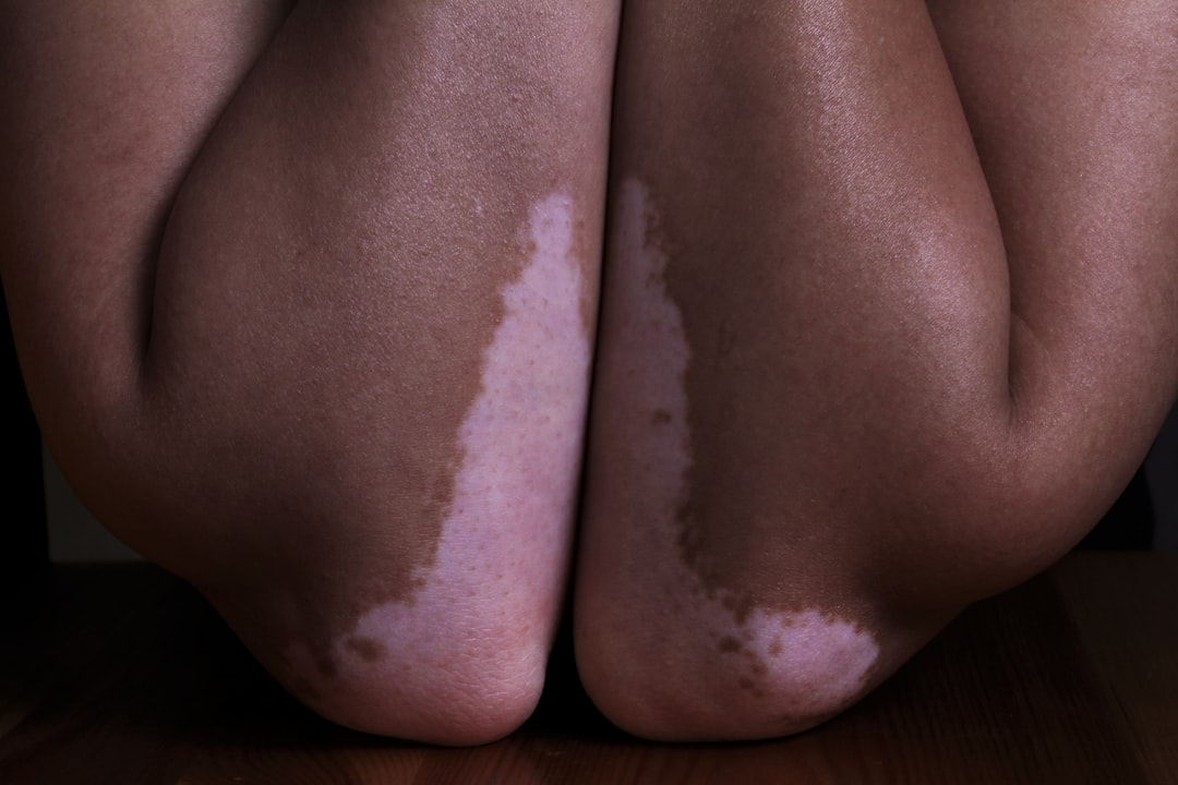 Cushing's Syndrome