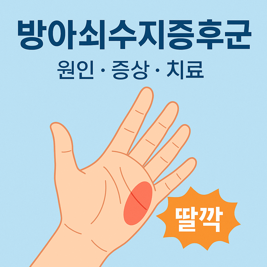 방아쇠수지증후군