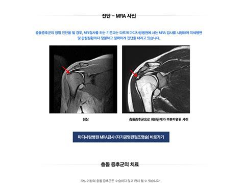 어깨충돌증후군수술