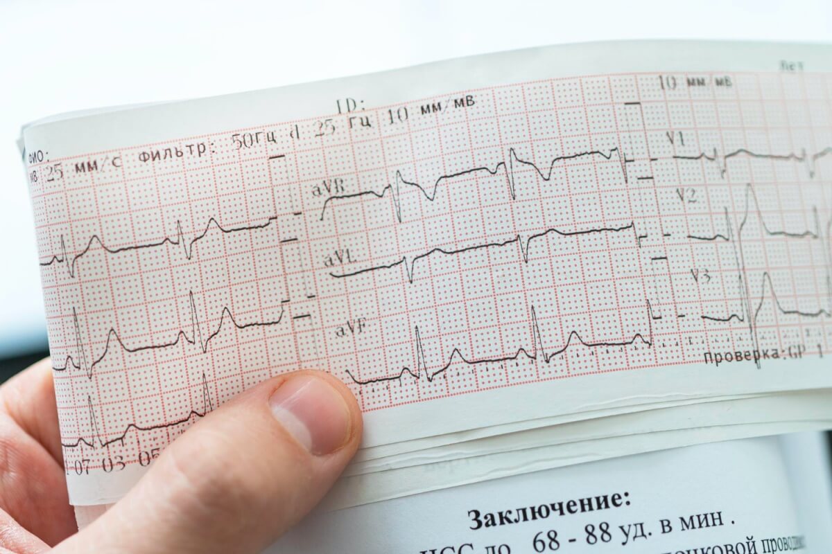 평균보다-심박수가-느린-동성서맥환자