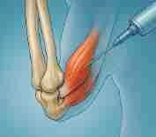테니스엘보 치료법