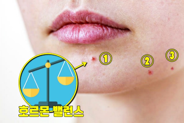 호르몬 불균형 증상, 턱 여드름 원인, 턱 여드름 자궁,여성질환
