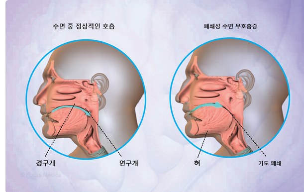 수면 중 정상호흡&#44; 수면 무호흡증