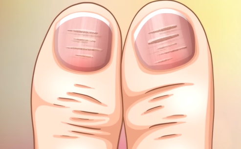 손톱에 세로줄이 생기는 이유