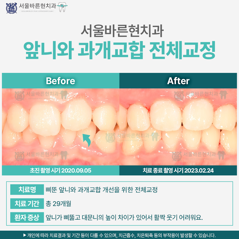 해운대치아교정