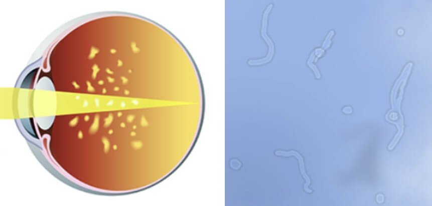비문증 증상 설명