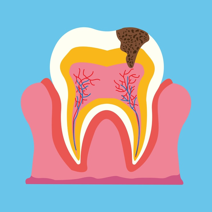충치가 신경까지 퍼진 사진