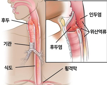 역류성 후두염