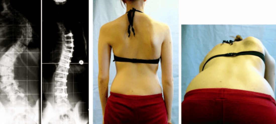 척추 증상 사진