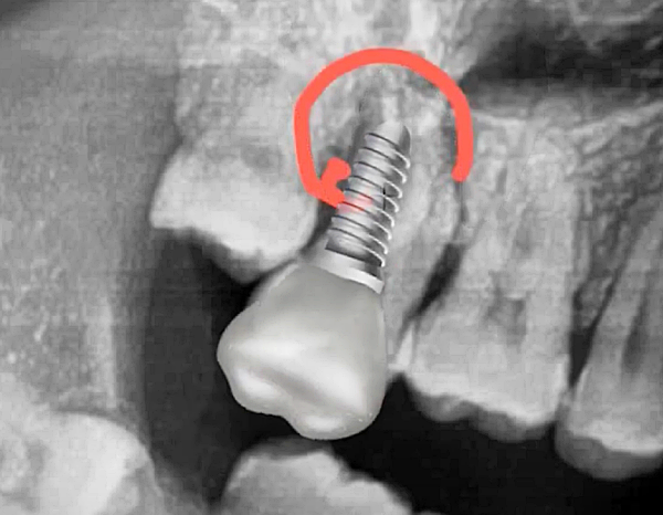 재신경치료과정, 보철물 제작 및 장착_출처:유튜브라이브치과병원