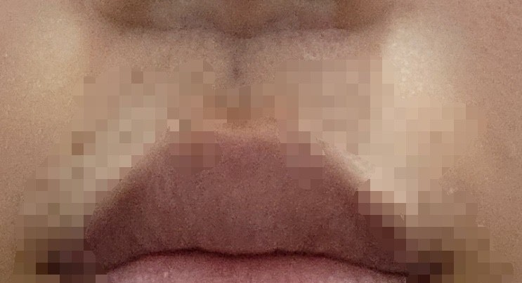 인중 축소 수술 후기