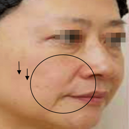 미니리프팅 수술 전 여성의 모습 예시