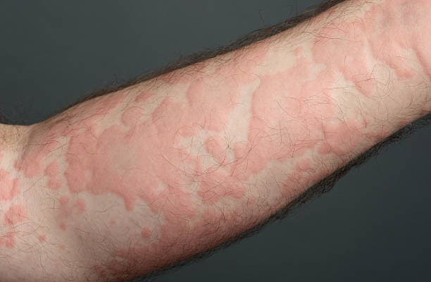 한랭 두드러기: 냉장고 문만 열어도? 찬 공기에 생기는 두드러기