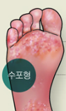 발에 수포가 생기는 수포형 무좀