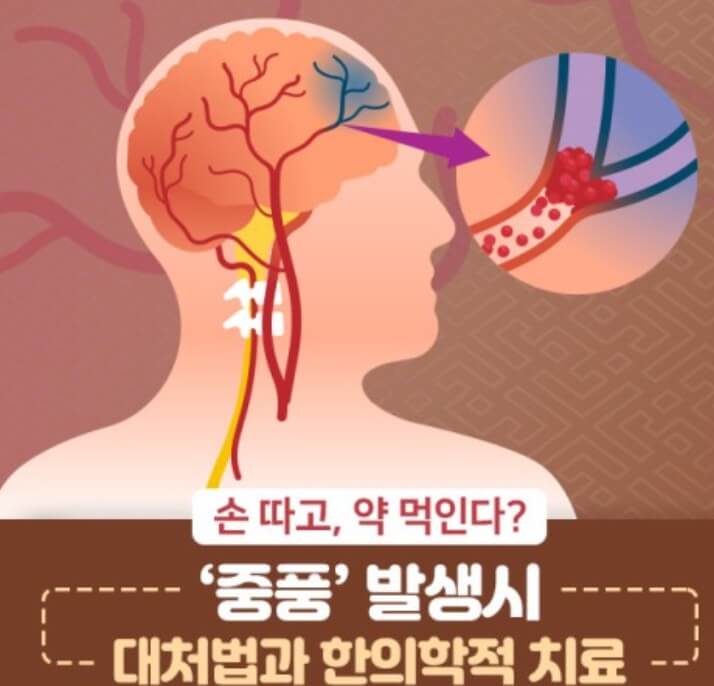중풍 치료법