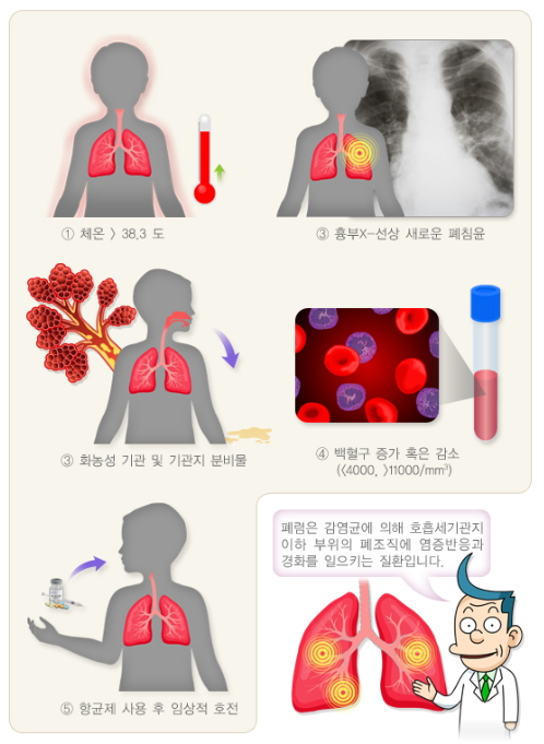 세균성 폐렴의 진단기준