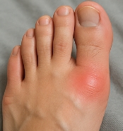 통풍에 좋은 음식