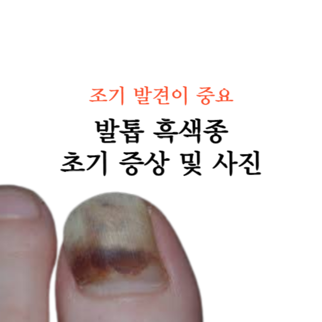 발톱-흑색종-초기-증상-치료-사진