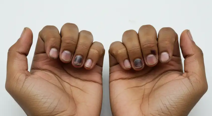 손톱변색 vs 손톱피멍, 구분법, 대처방법