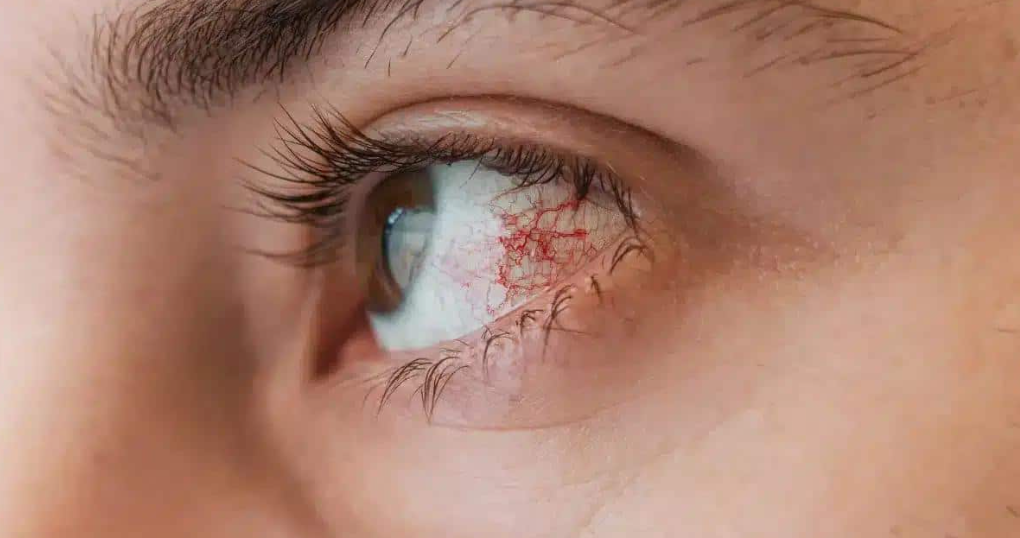 결막염,충혈된 눈