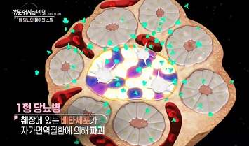 1형당뇨병