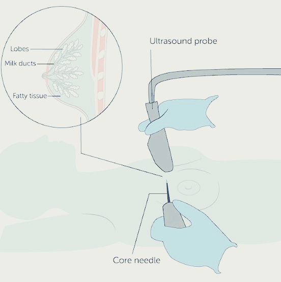 유방총조직검사