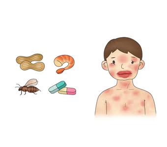 아나필락시스 쇼크 관련 사진