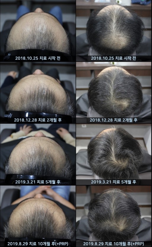 PRP 탈모 치료