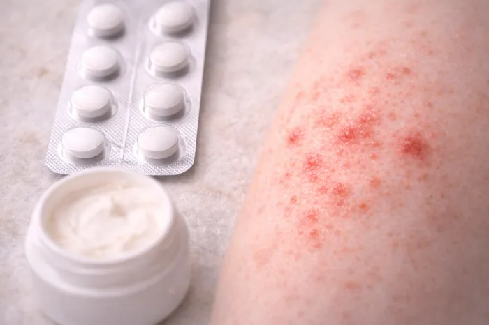 피부에 붉은반점이 생기는 이유