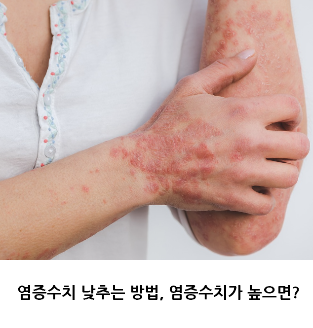 염증수치 낮추는 방법, 염증수치가 높아지면?