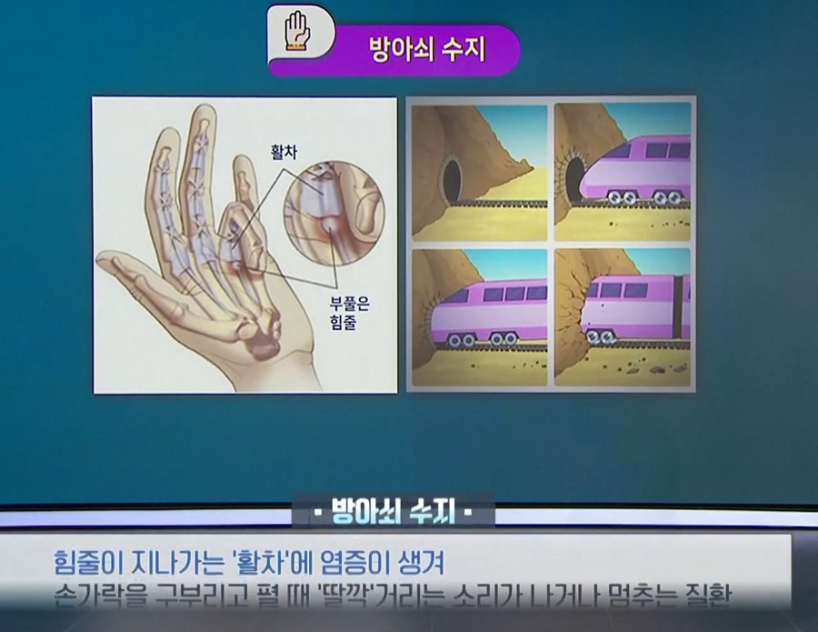 EBS명의-손목-명의-이재성-교수-수부세부-정형외과