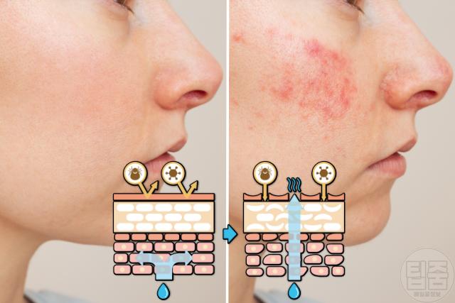 피부장벽 무너짐 증상 피부장벽무너졌을때