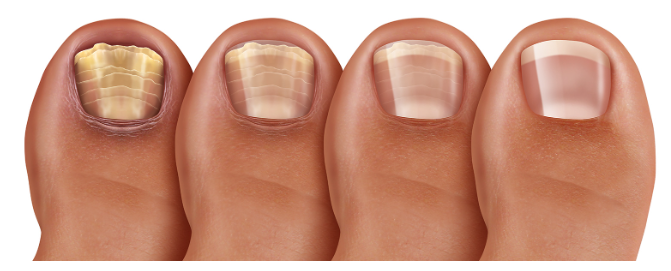 무좀 증상별 무좀약 추천