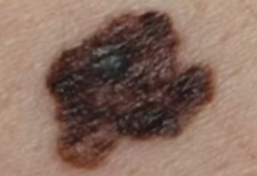 노년층 흑색종 대비법 (자각증상, 검진주기, 관리)