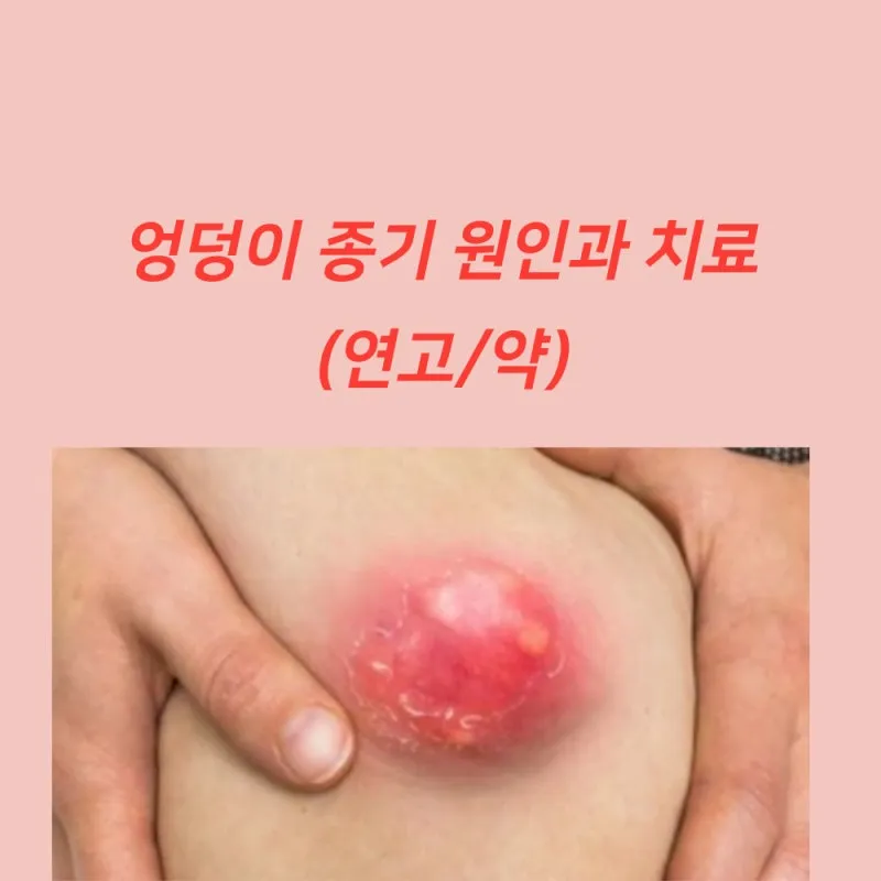 엉덩이 종기가 생기는 이유 왜 생기고 어떻게 관리할까요 완벽 가이드_2