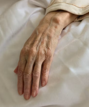 검버섯 없애는 방법 민간요법 얼굴 손등