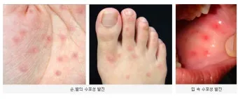 수족구병 증상과 예방 조치 방법 모음_2