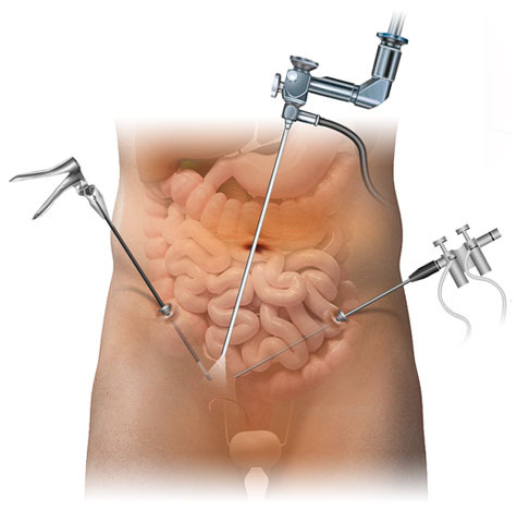 맹장염 복강경수술 방식
