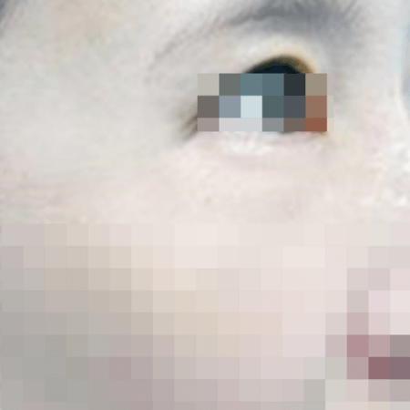 하안검수술 후 여성의 모습 예시