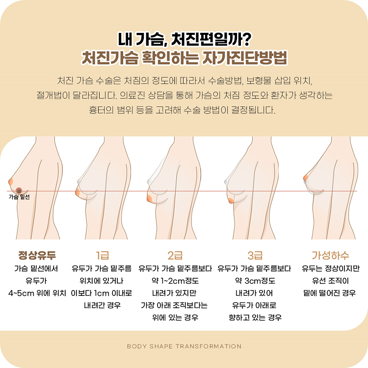 처진 가슴 수술은 처짐의 정도에 따라서 수술방법, 보형물 삽입 위치, 절개법이 달라집니다. 의료진 상담을 통해 가슴의 처짐 정도와 환자가 생각하는 흉터의 범위 등을 고려해 수술 방법이 결정됩니다.