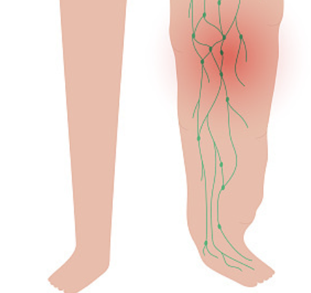 백혈병 초기증상 29