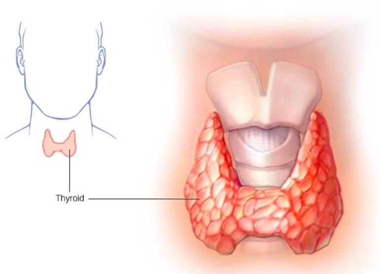 갑상선기능항진증원인