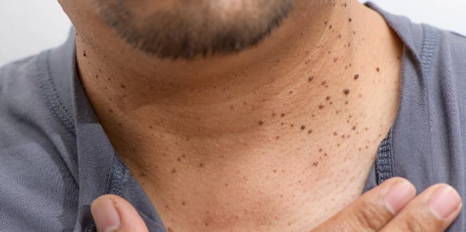 검버섯 없애는 방법 및 검버섯 원인 총정리