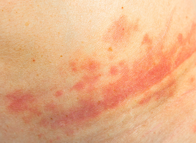 피부 붉은반점 이유 12가지 총정리 섬네일