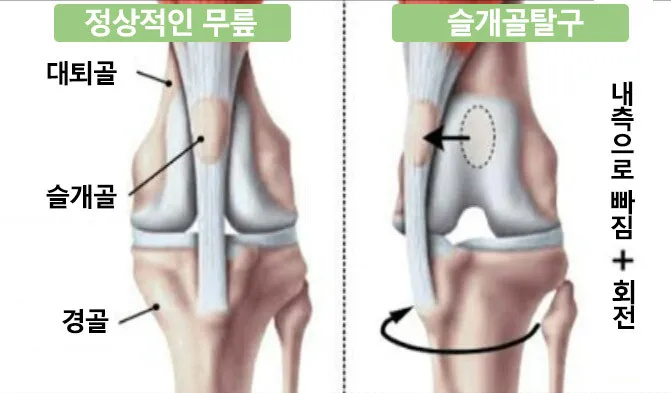 강아지 슬개골 탈구 수술 후유증_1