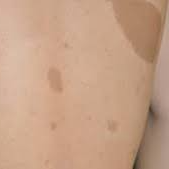 신경섬유종 초기 증상, 혹시 나도? 놓치면 안 되는 신호