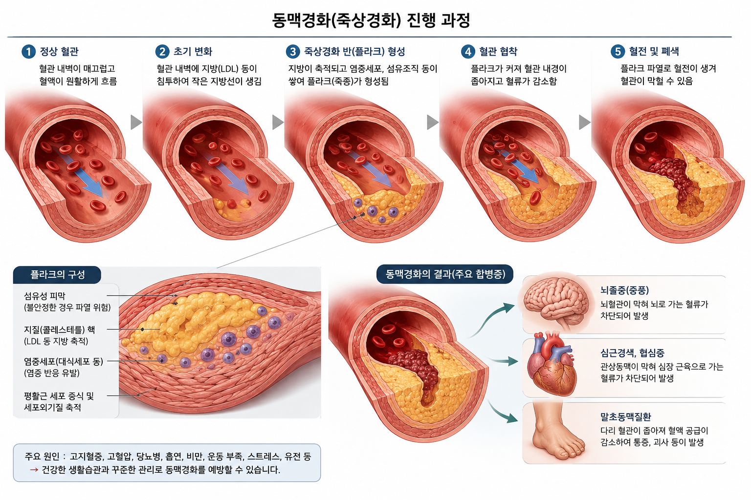 동맥경화 진행과정