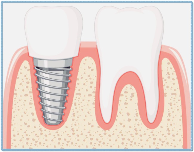 건강보험 임플란트