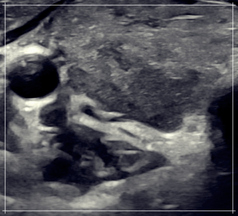 아급성 갑상선염: 증상과 치료법에 대해 상세히 알아보기