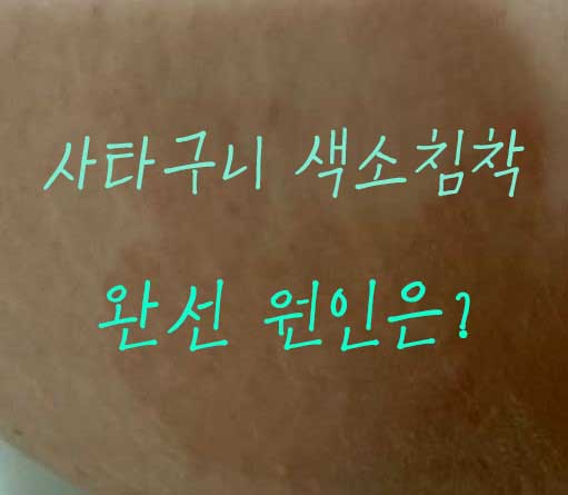 사타구니-색소침착-완선